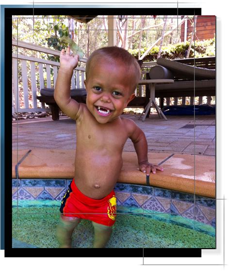 Dwarfism In Babies