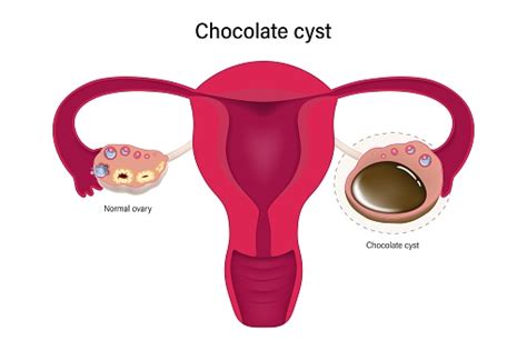 Chocolate Cyst Female Ovarian Disease Vector Ovarian Cyst With Female ...