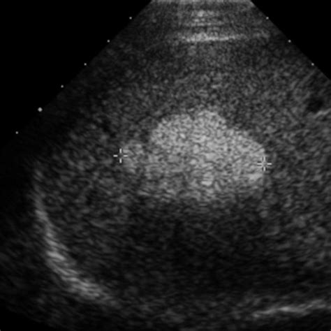 Liver Glycogen Storage Disease Ultrasound