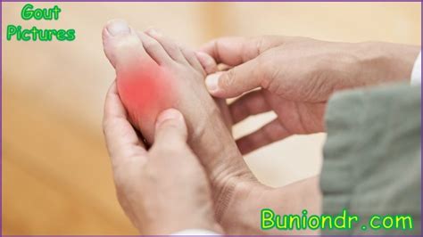 Gout Vs Bunion The Difference Between Gout And Bunion