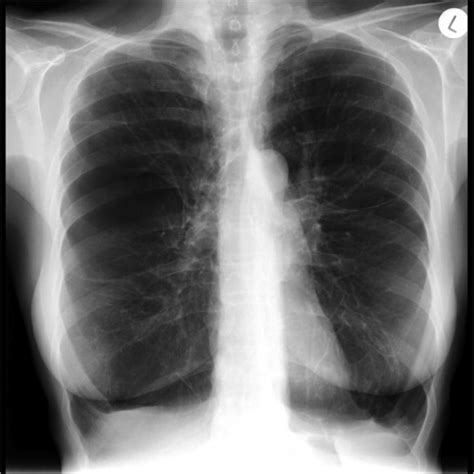 Various Radiographic X Ray Representations Of Emphysematous Lungs In