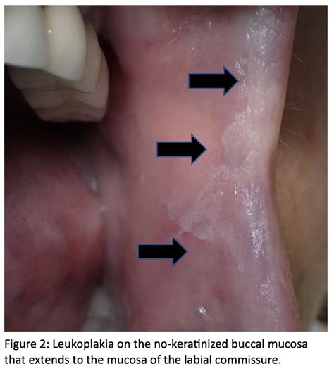 Leukoplakia Buccal Mucosa 