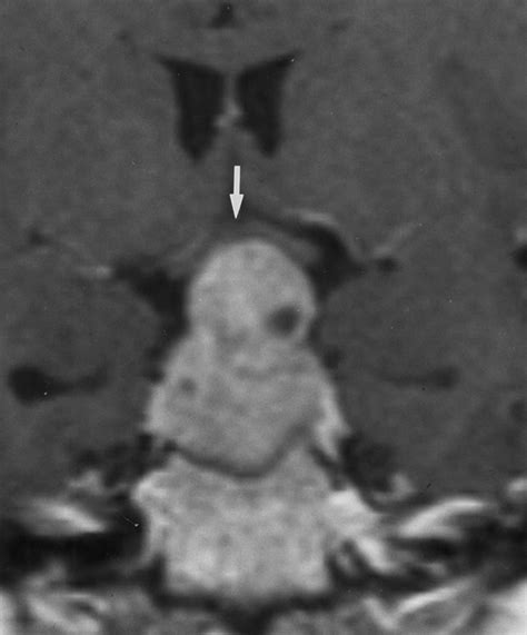 MR Imaging of Pituitary Adenomas After Gamma Knife Stereotactic