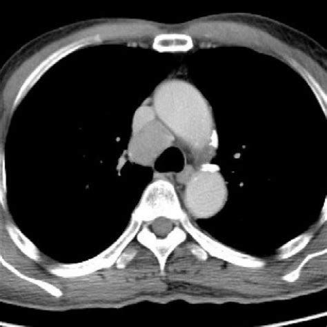 Computed Tomography Scan Showing Mediastinal Lymph Node Adenopathy Download Scientific Diagram