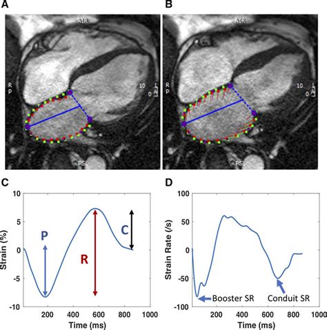 Left Atrial Phasic Function By Cardiac Magnetic Resonance Feature