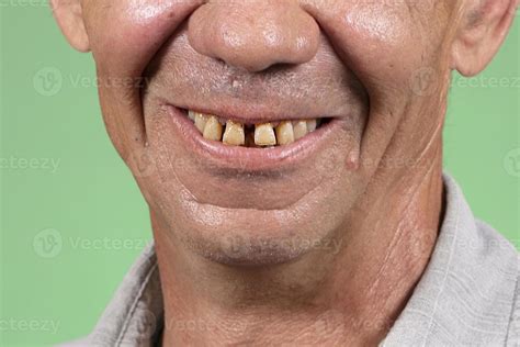 Part Of The Face With Ugly Yellow And Sparse Teeth Dental Problems Of