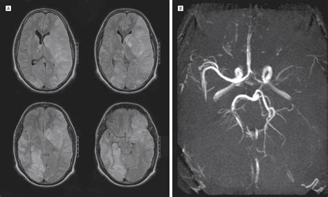 Acute Posterior Multifocal Placoid Pigment Epitheliopathy With Cerebral