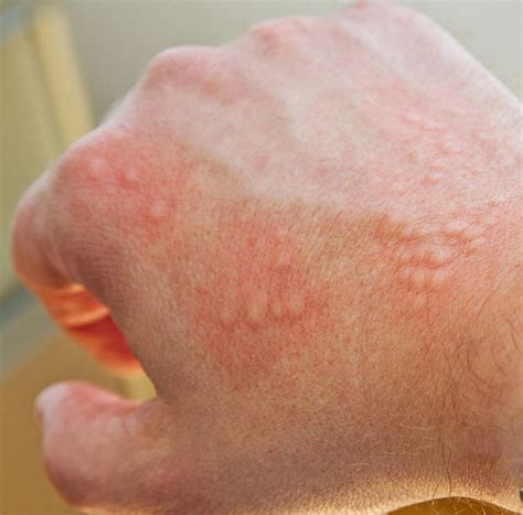 Allergic Reaction Skin Rash Itchy