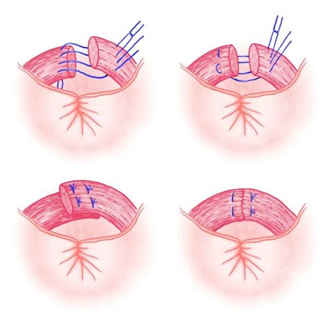 Methods For Surgical Repair Of Anal Sphincter Tears Overlap Technique