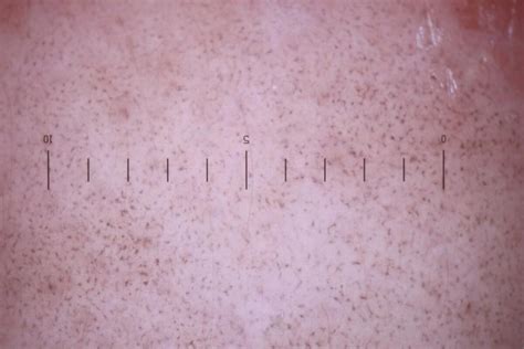 Lichenoid Keratosis