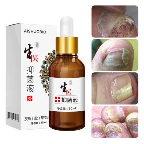 Fungus Removal Infection Feet Care Anti Fungal Powerful Herbal Foot ...