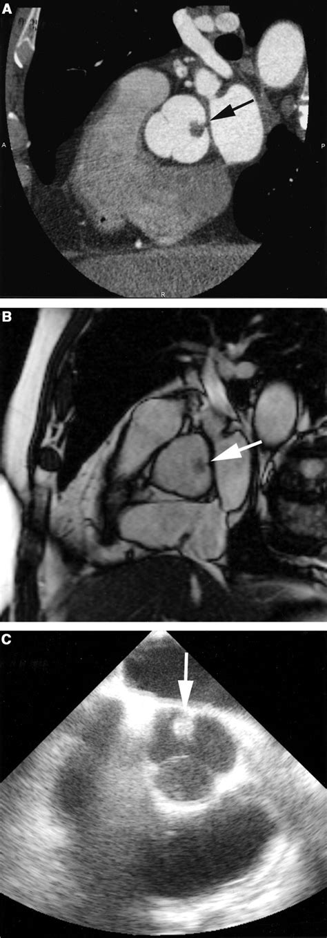 papillary fibroelastoma   aortic valve circulation