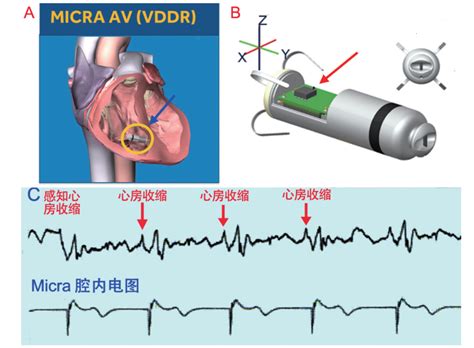 心脏起搏器2——弥补传统起搏器缺陷，无导线心脏起搏器简介行业分析