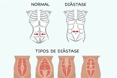 Di Stase Abdominal O Que Como Identificar E O Que Fazer Tua Sa De