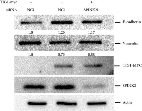 SPINK2 SiRNAs Alleviate TIG1 Regulated EMT NT2 D1 Cells Were