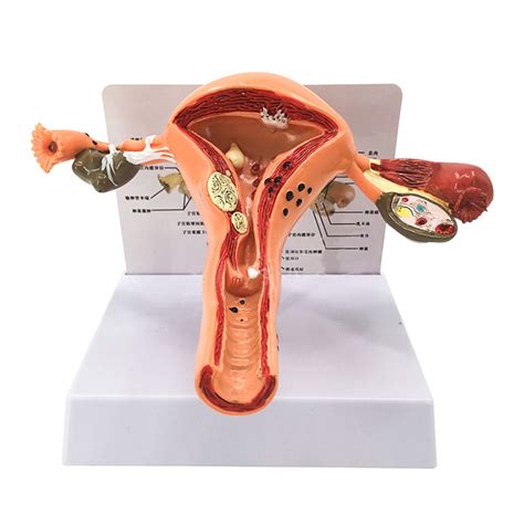 Buy LBYLYH Female Pathological Uterus Anatomy Model Ovarian Model