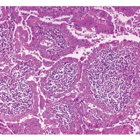 Pdf Warthin Tumor Like Papillary Thyroid Carcinoma With A Minor