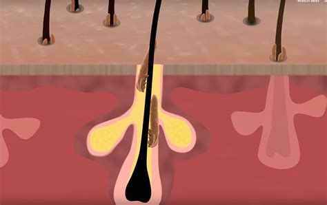 Grim Video Reveals Face Mites Feast On Your Skin And Have Sex On You While You Sleep The Irish Sun