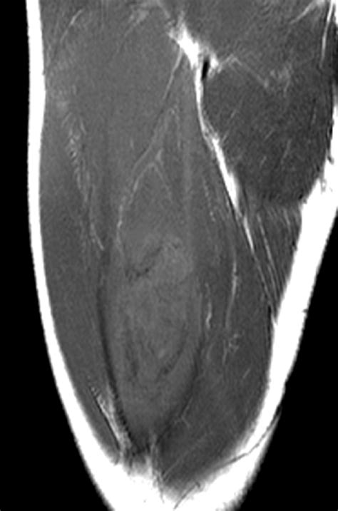 Myositis Ossificans Radsource