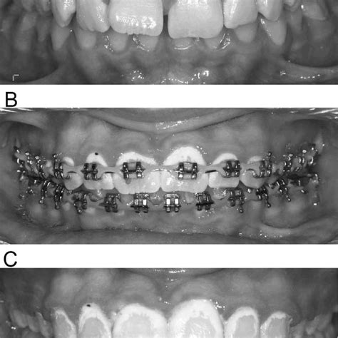 Pdf Effect Of Fluoride Dentifrices On White Spot Lesions During