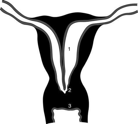 Features Of The Patient S Condition 1 Complete Septate Uterus With