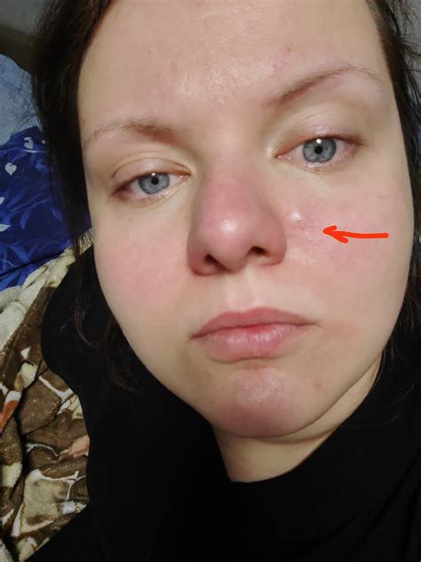 Небольшая шишка на лице - Вопрос дерматологу - 03 Онлайн