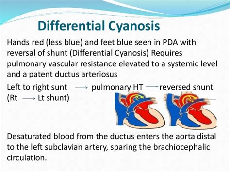 Child with cyanosis