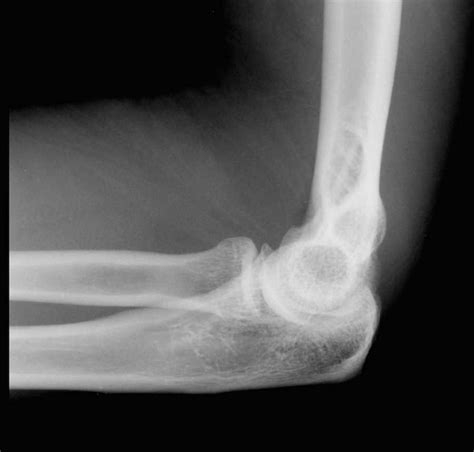 normal elbow  rays elbow  ray interpretation xaszry