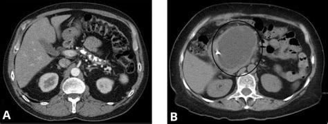 Chronic Pancreatitis Clinical Features Investigations Teachmesurgery