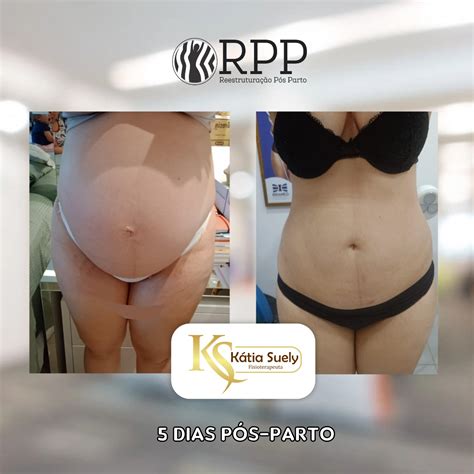 Taping Pos Parto Antes E Depois - Tape Pos Parto – STETIC ACADEMY