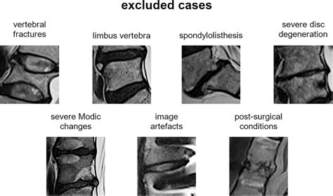 excluded cases   selection   intervertebral spaces