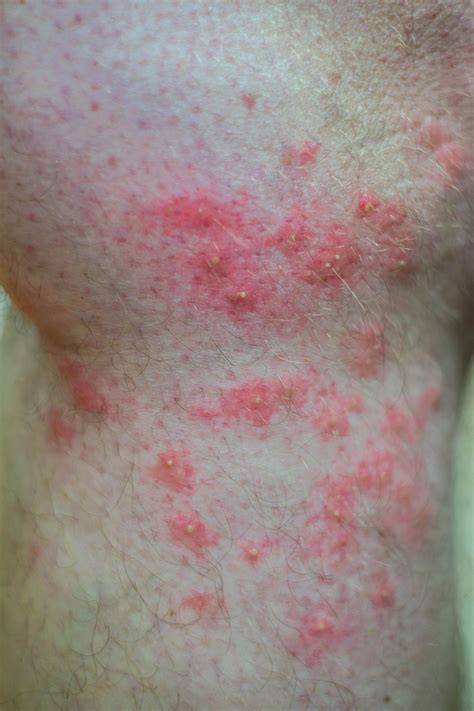 These Bug Bite Pictures Can Help You Identify A Mosquito Bite, Tick