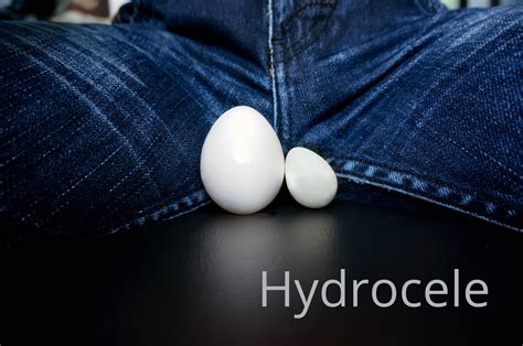 facts  hydroceles facty health