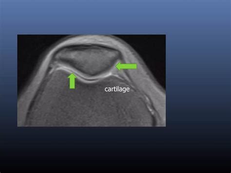 Cartilage imaging simplified | PPT