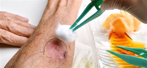 guide  proper wound cleaning  absorbent dressings