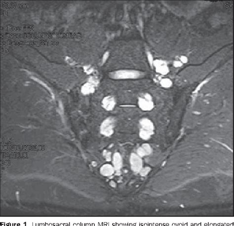 Plexiform Neurofibroma Mri