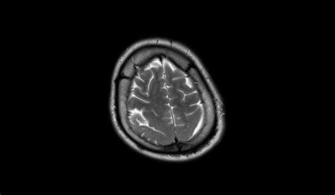 Pachygyria MRI | Radiology Article on Oligodendroglioma