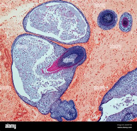 Dermoid Ovarian Cyst Light Micrograph Of A Section Through An Ovary