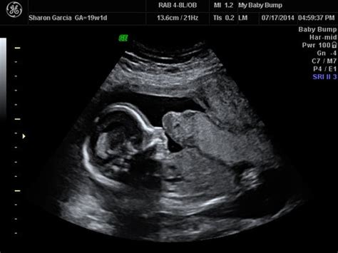 placental abruption babycenter