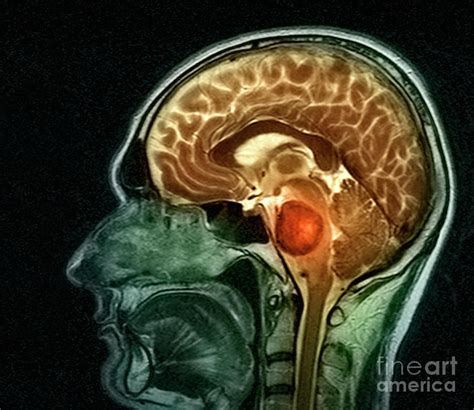 Brain Tumour Photograph By Simon Fraser Science Photo Library Fine