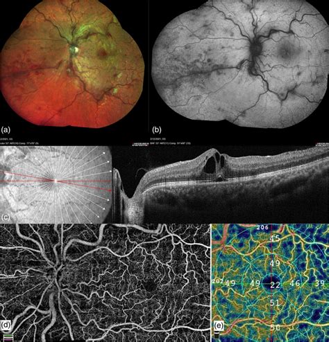 Multimodal Imaging Of Left Eye Central Retinal Vein Occlusion Post