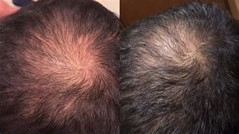 СПРЕЙ ОТ ВЫПАДЕНИЯ ВОЛОС АТОМИ