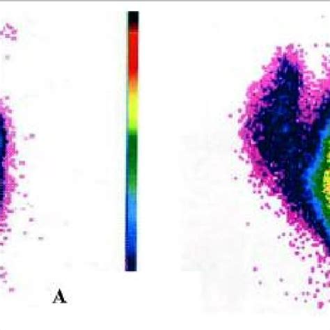 Scintigraphic Images Normal Thyroid Left Plummers Disease Right Download Scientific Diagram