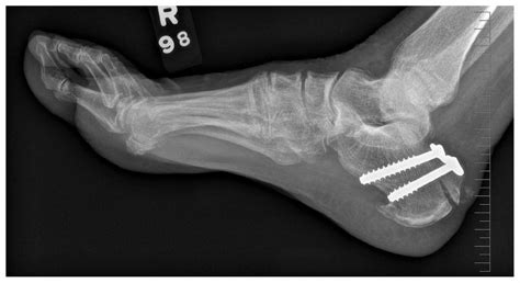 Avulsion Fracture Diagram Fracture Avulsion Calcaneus Poster