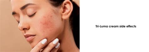 How To Treat Melasma With Tri Luma Cream A Comprehensive Guide