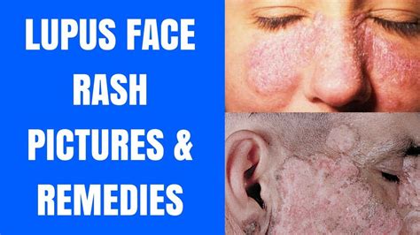 Lupus Face Rash - Lupus Face Rash Pictures - Lupus Face Rash Chin ...