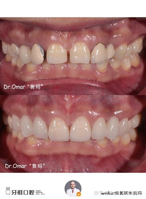 修复案例：上颌2颗门牙做了「冠延长术」修复8颗「全瓷贴面」 知乎