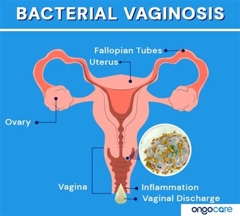 Bacterial Vaginosis Symptoms Causes Diagnosis And Treatment