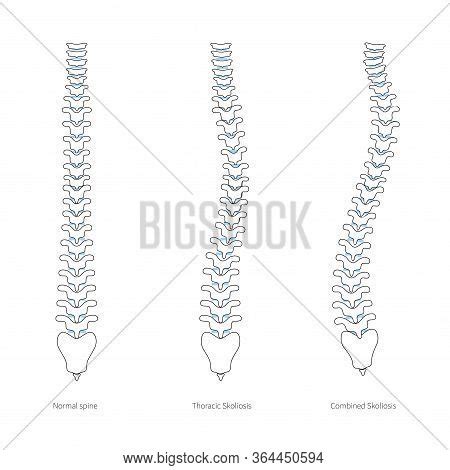Scoliosis Flat Vector Vector & Photo (Free Trial) | Bigstock