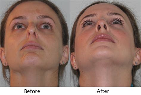 Drastic Results From Repairing Collapsed Nostrils With New York Sinus